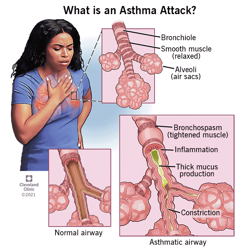 Asthma evaluation and treatment at PulmoCrit Associates