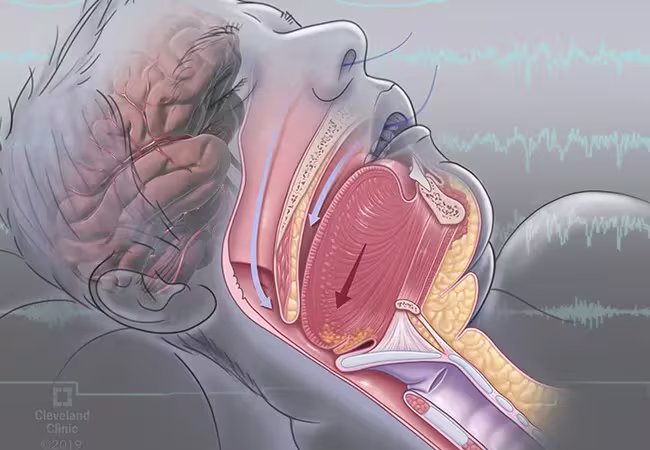 Sleep apnea and heart health cardiovascular risk