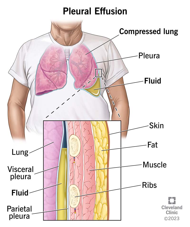 Pleural effusion chest imaging