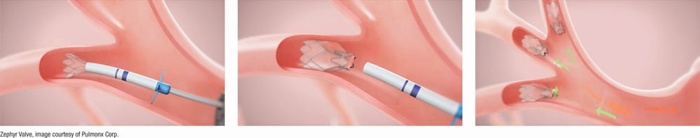 Zephyr valve bronchoscopic placement procedure — three-step illustration